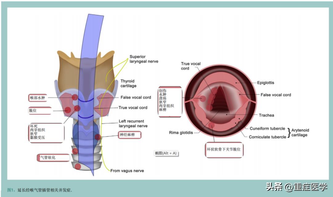 气管插管手术后遗症咳嗽,气管切开后插管后并发症及处理