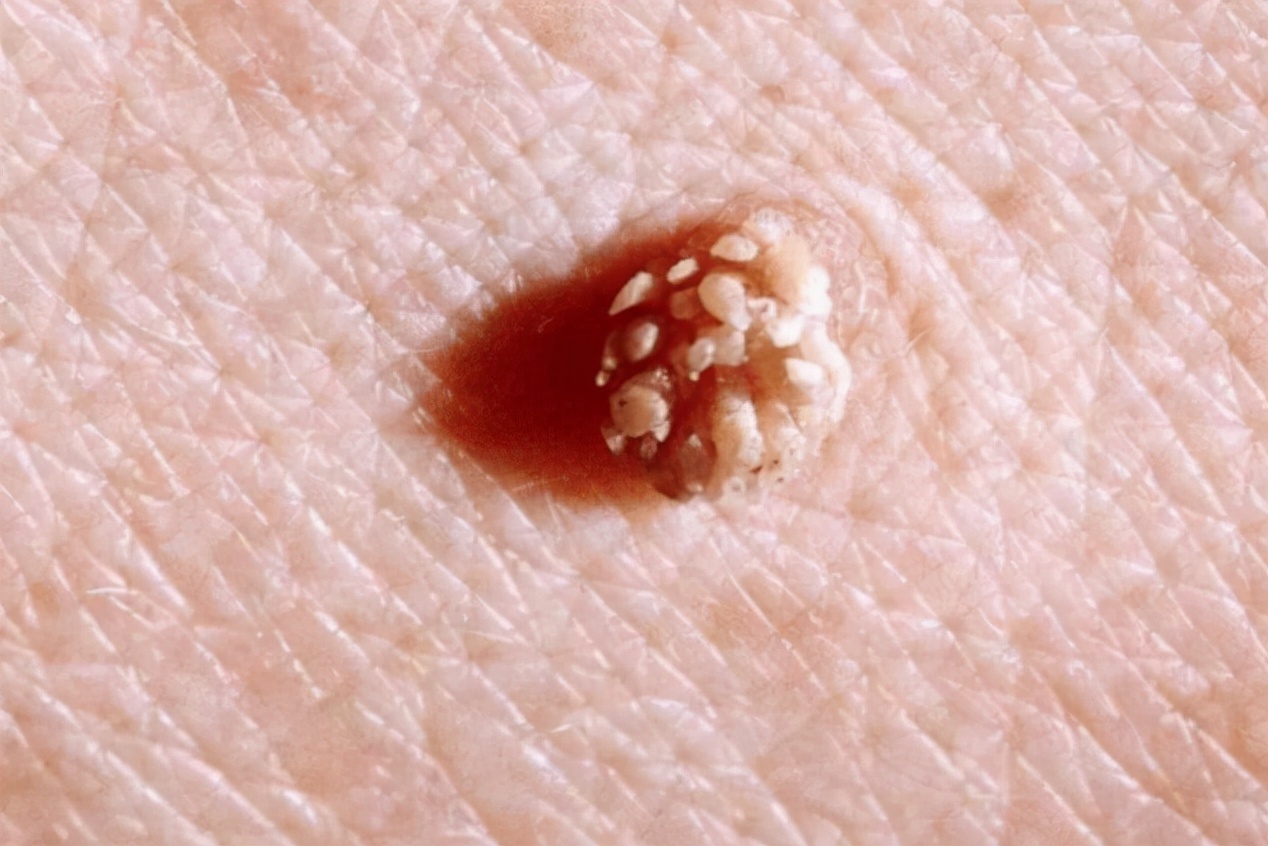 21岁女生到医院检查hpv病,29岁女子检查hpv16感染