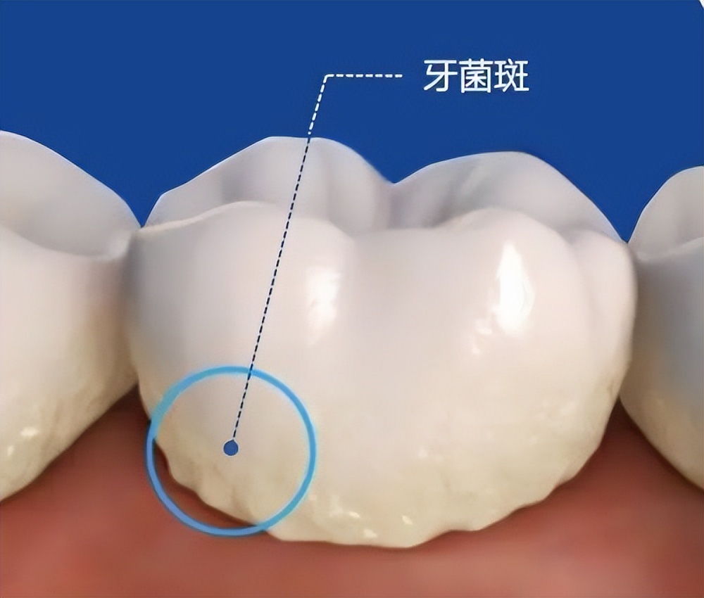 电动牙刷的好处和坏处,电动牙刷好用还是手动牙刷好用