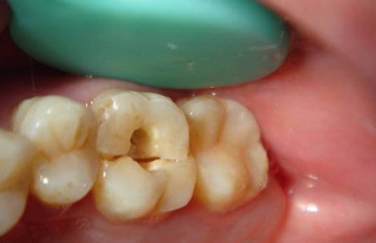 牙做了根管治疗疼得更严重怎么办,做过根管治疗的牙齿又疼了正常吗