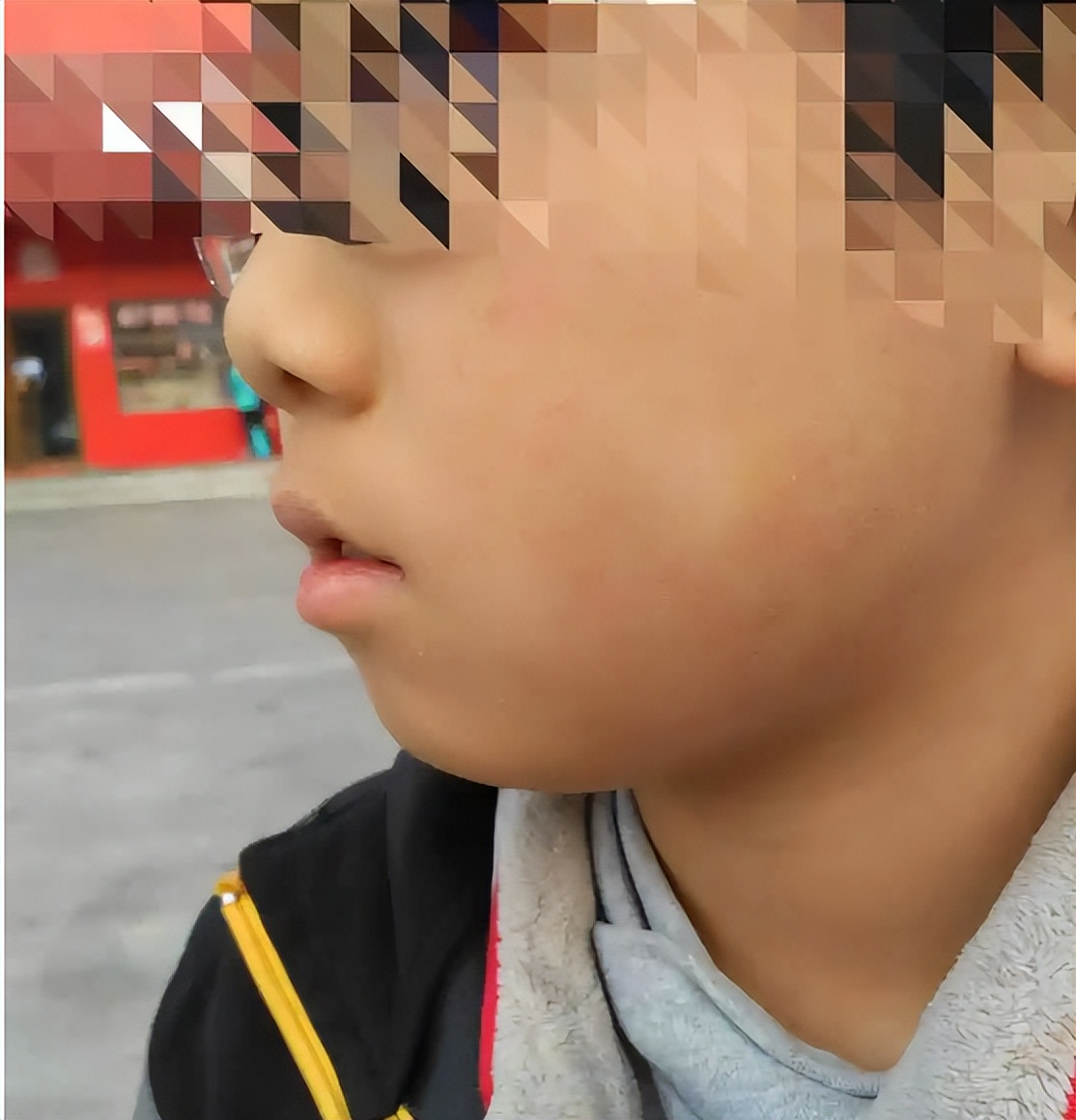 儿童白色糠疹症状,儿童脸上白色糠疹白斑怎么消除