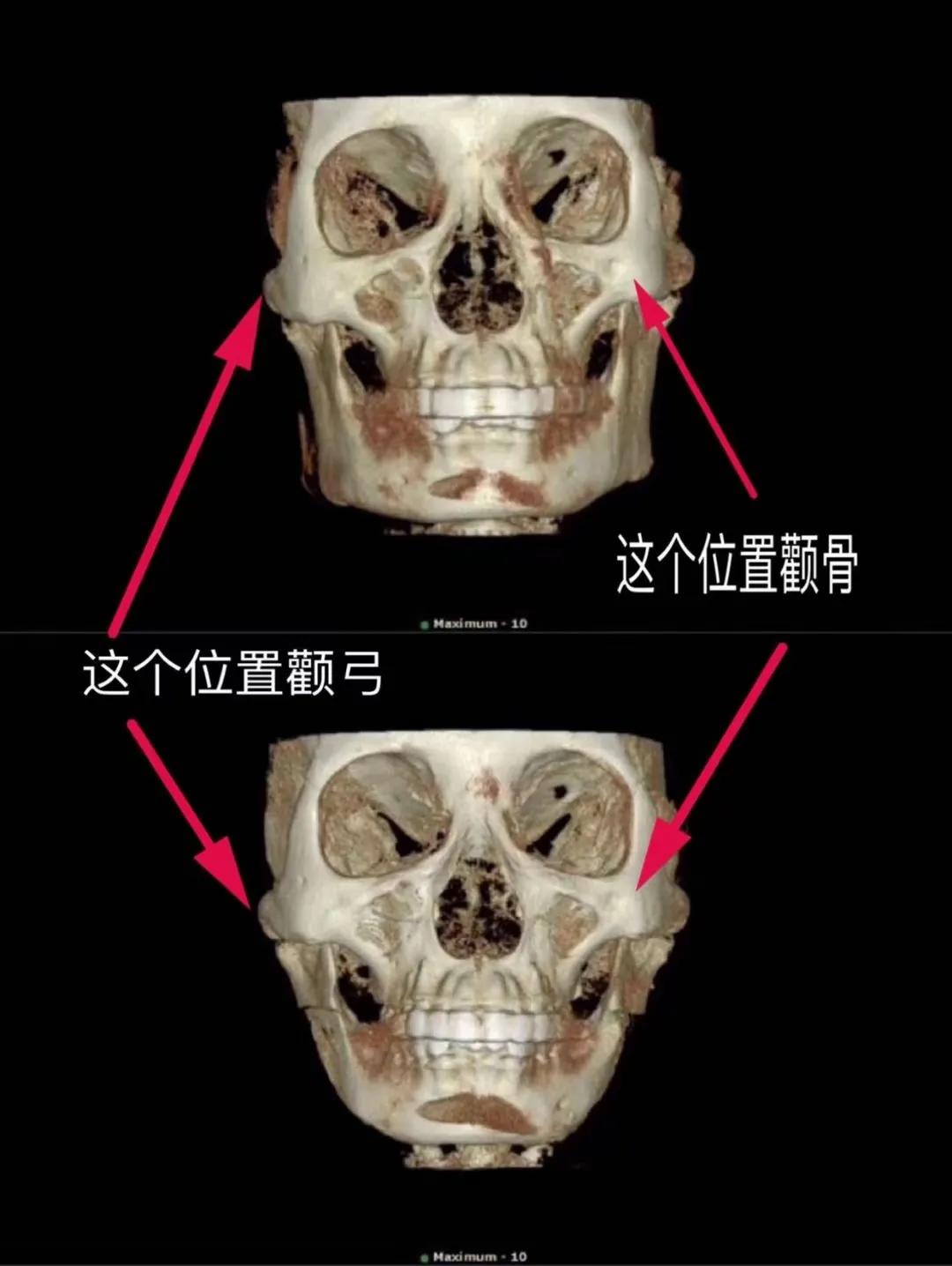颧骨内推术后10天脸还消不了肿,颧骨颧弓内推手术后多久能消肿