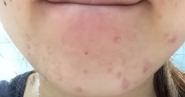 美容师祛痘必学的专业知识脸部,美容院正确清痘的护理流程