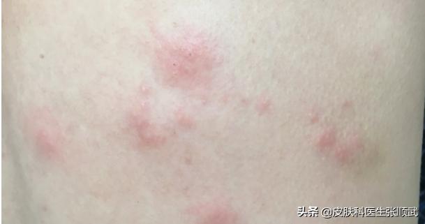 腰疼五天后起疹子,带状疱疹快好了腰疼是怎么回事