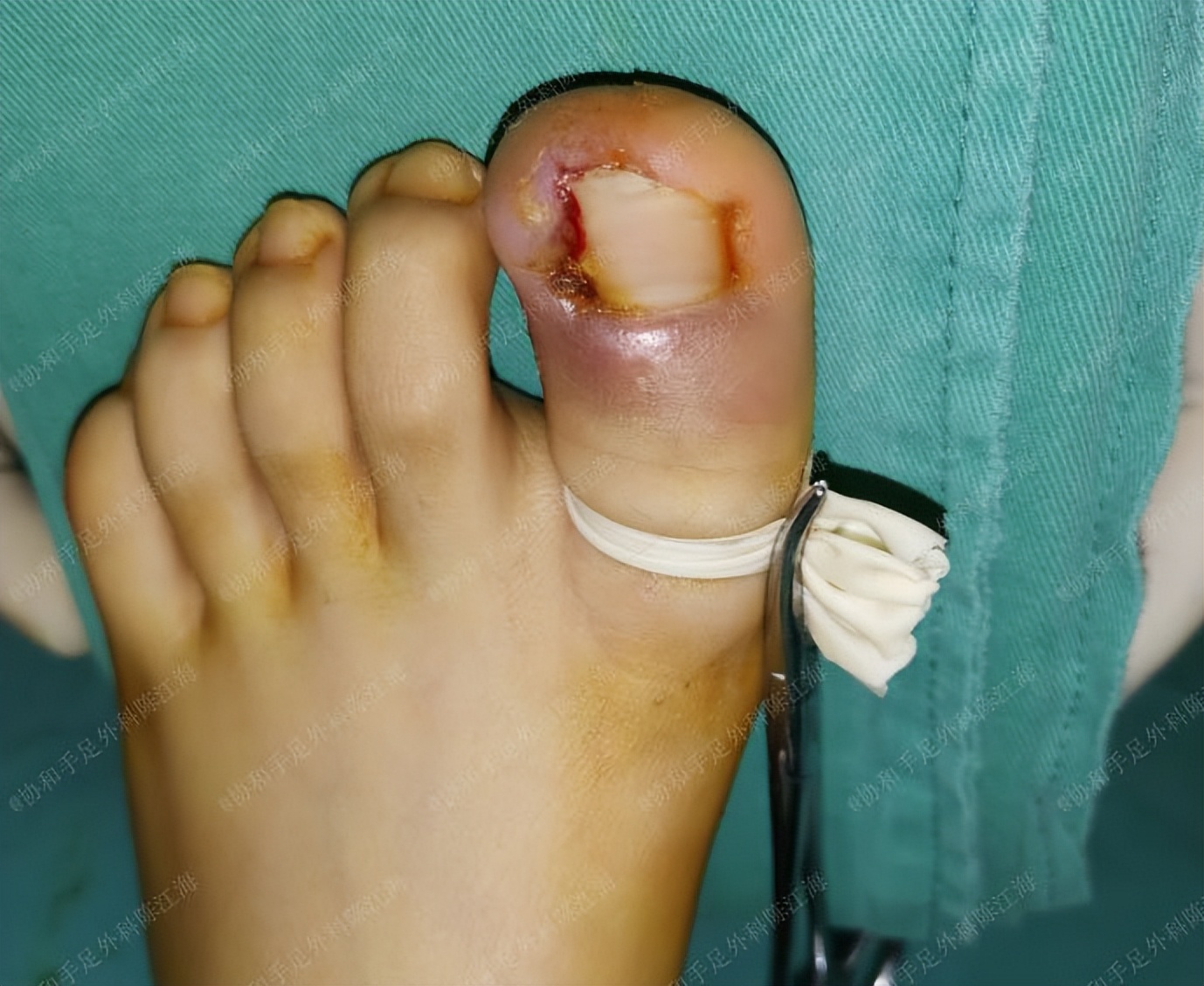 嵌甲怎么治疗才能彻底除根,嵌甲使用什么方法可以彻底根治