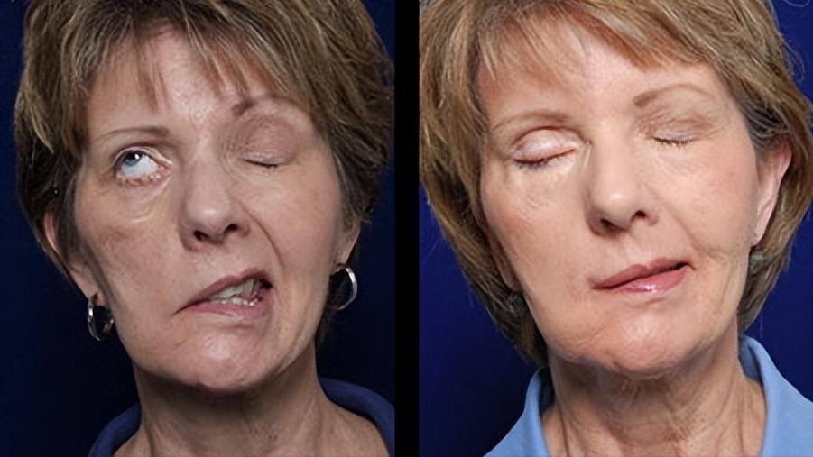 面神经麻痹后遗症的最佳治疗方法,面神经麻痹面部有麻木感觉吗