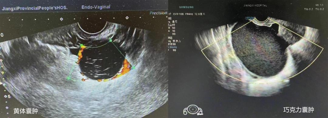 仁医科普|卵巢囊肿是什么？该如何处理？