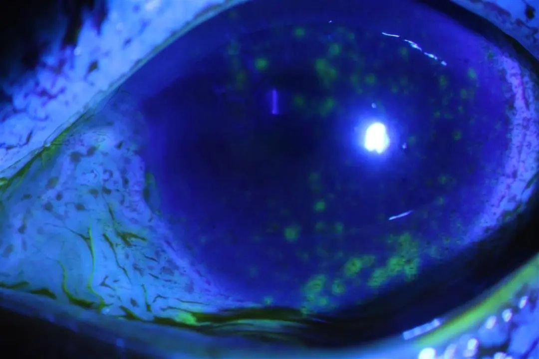 染发后，她“泪流满面”地走进眼科诊室