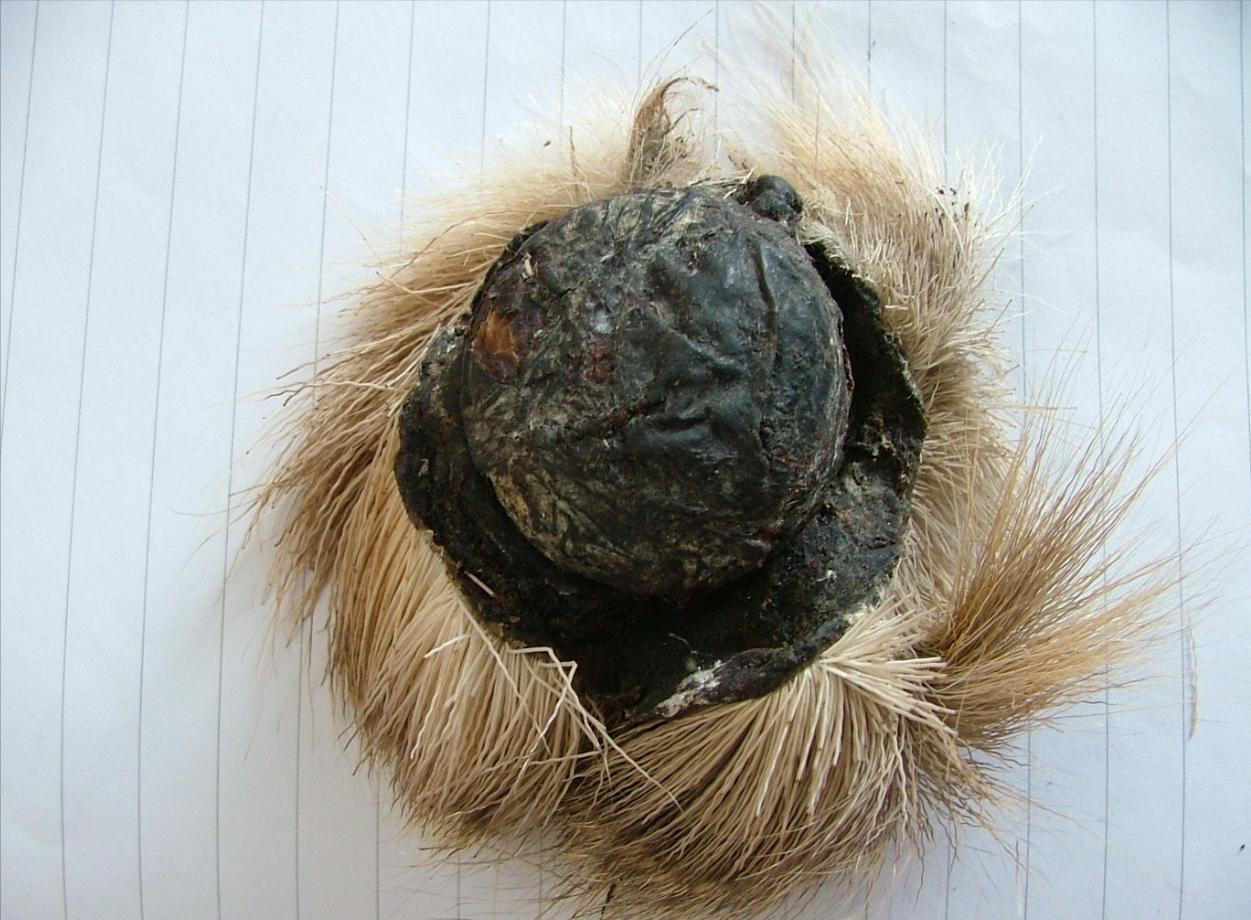 中成药小金丹组方,巧克力囊肿用小金丹管用吗