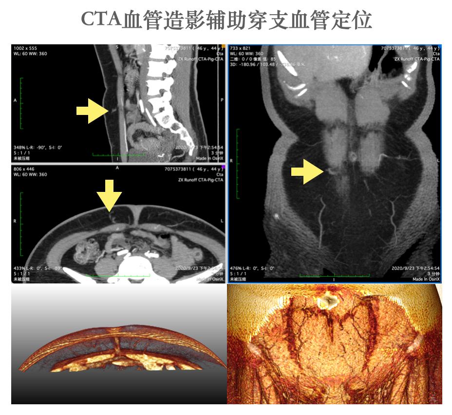 乳腺癌一期假体再造术,乳腺重建与乳房再造