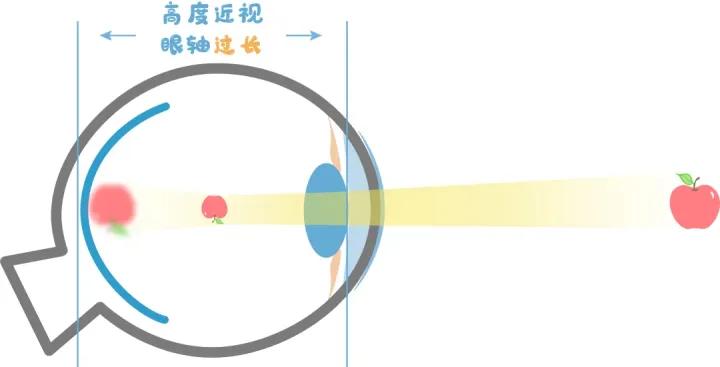 散瞳意味着什么,散瞳什么危害