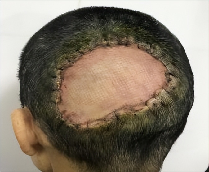 脱发后毛发还能移植吗,毛发移植会脱发吗