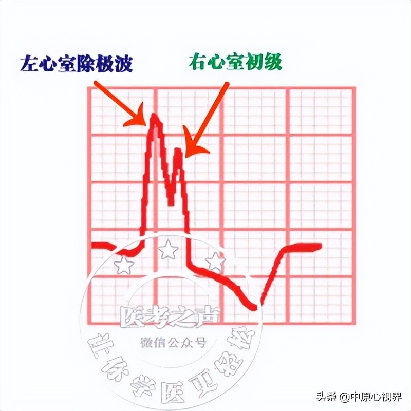 护考几种常见的心电图,常见的心电图图形分析