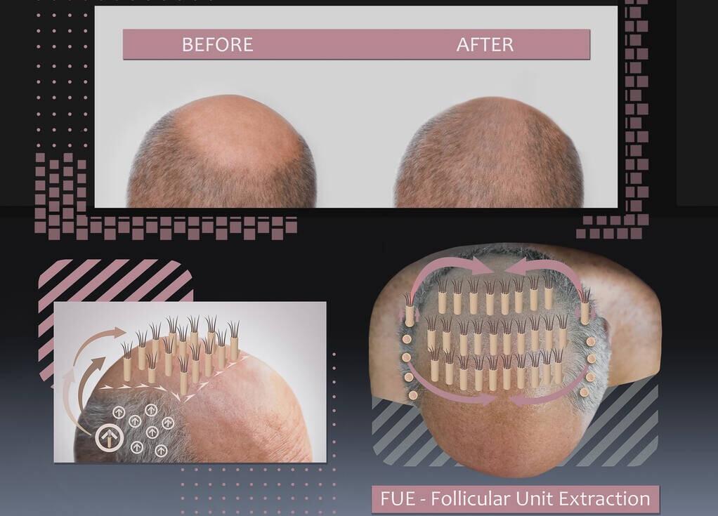 头顶头发稀少小妙招,头顶头发稀少最有效的方法
