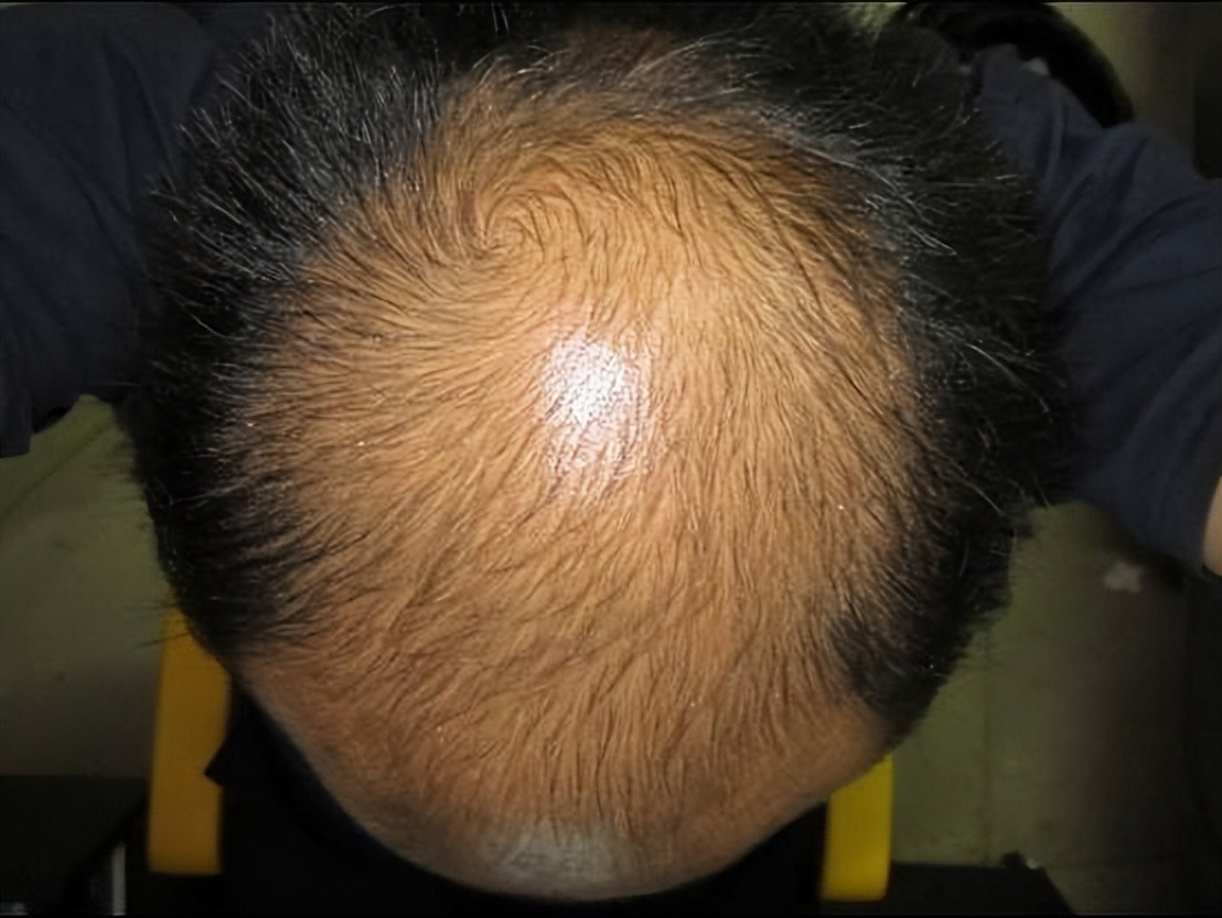 脱发为什么都是从头顶先秃,脱发为什么先从头顶脱