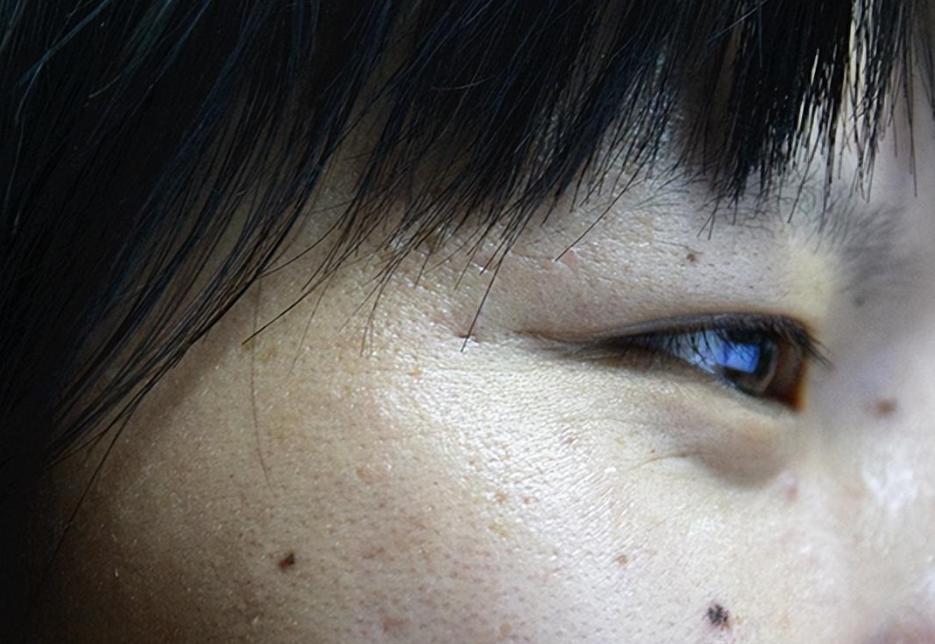 脖子上的小肉粒揪下去会变多吗,脖子腋下长小肉粒可以用手揪掉吗