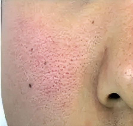 毛孔粗大的三大类型你属于哪一种,几种类型毛孔粗大改善的方法