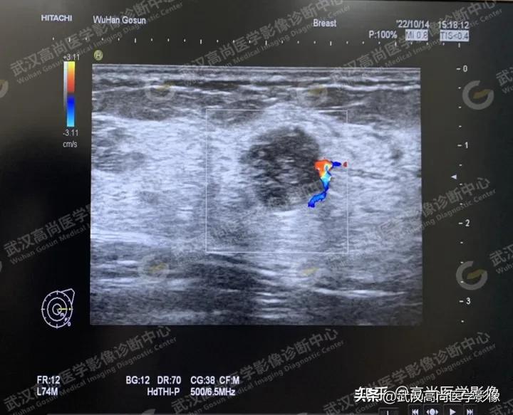 乳腺超声病例,乳腺肿块巨大超声结果4a