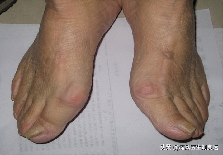 急性痛风吃秋水仙碱配什么,痛风吃秋水仙碱和非布司他的方法