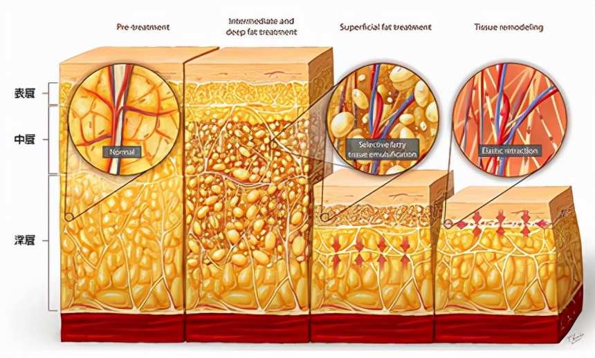 吸脂可以瘦胸吗,吸脂vs瘦腿针