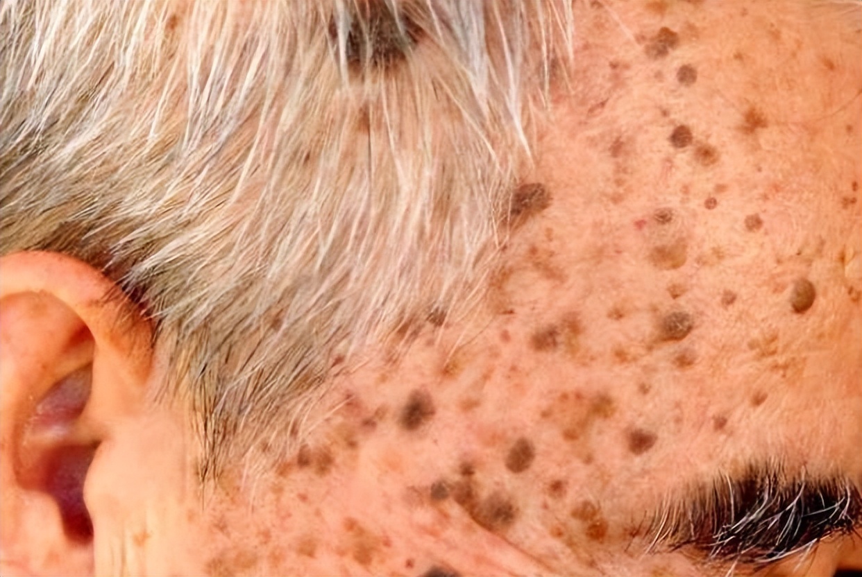 红霉素软膏真的能祛除老年斑吗,红霉素软膏去老年斑小妙招