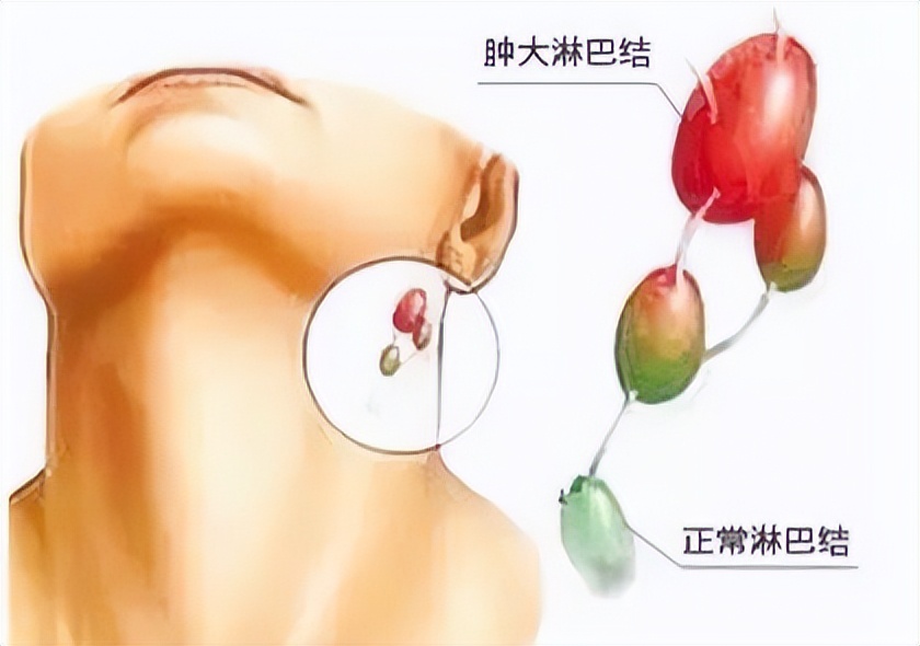 脖子上有包块是怎么回事,脖子上的丝状疣怎么去除