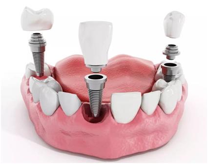 老年人可以种牙齿吗,惠民县老年人种牙