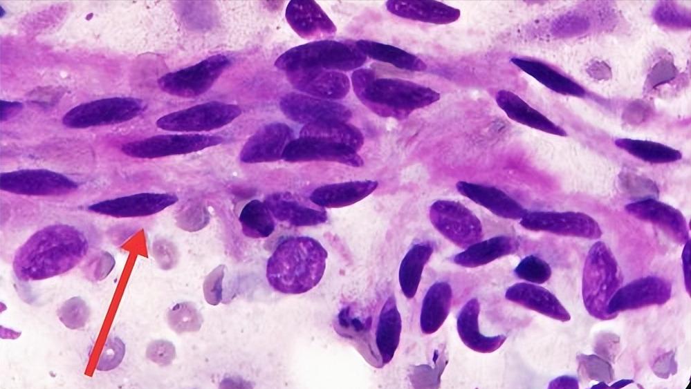 平滑肌瘤和平滑肌肉瘤是一样吗,平滑肌瘤和平滑肌肉瘤的区别