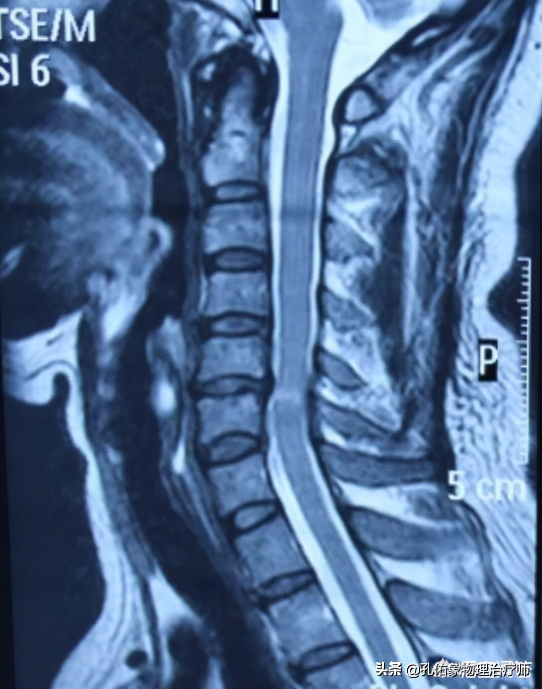 神经根颈椎病的症状和治疗方法,椎动脉颈椎病的症状和治疗方法