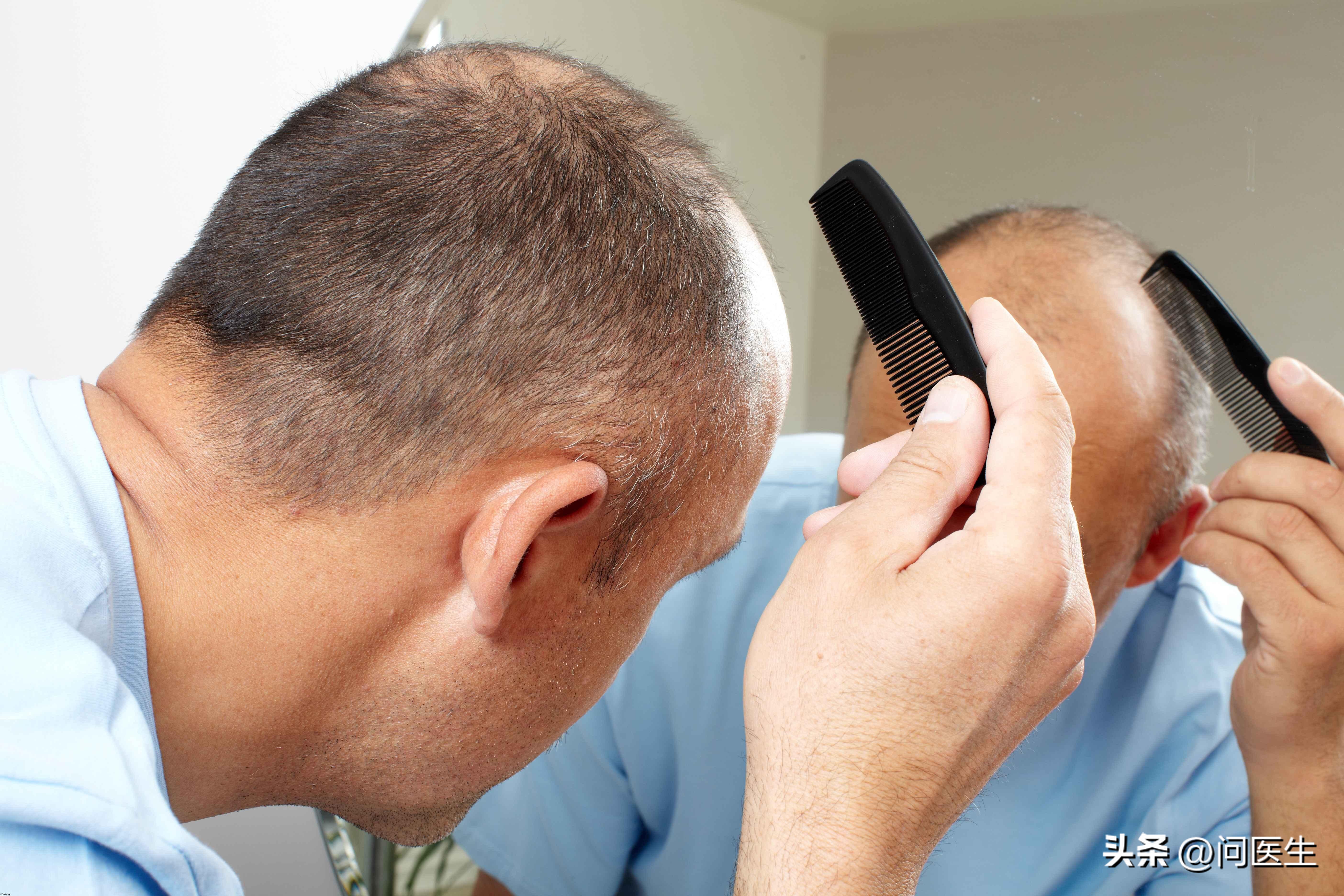 这两年发际线越来越高怎么办,发际线越来越高怎么制止脱发