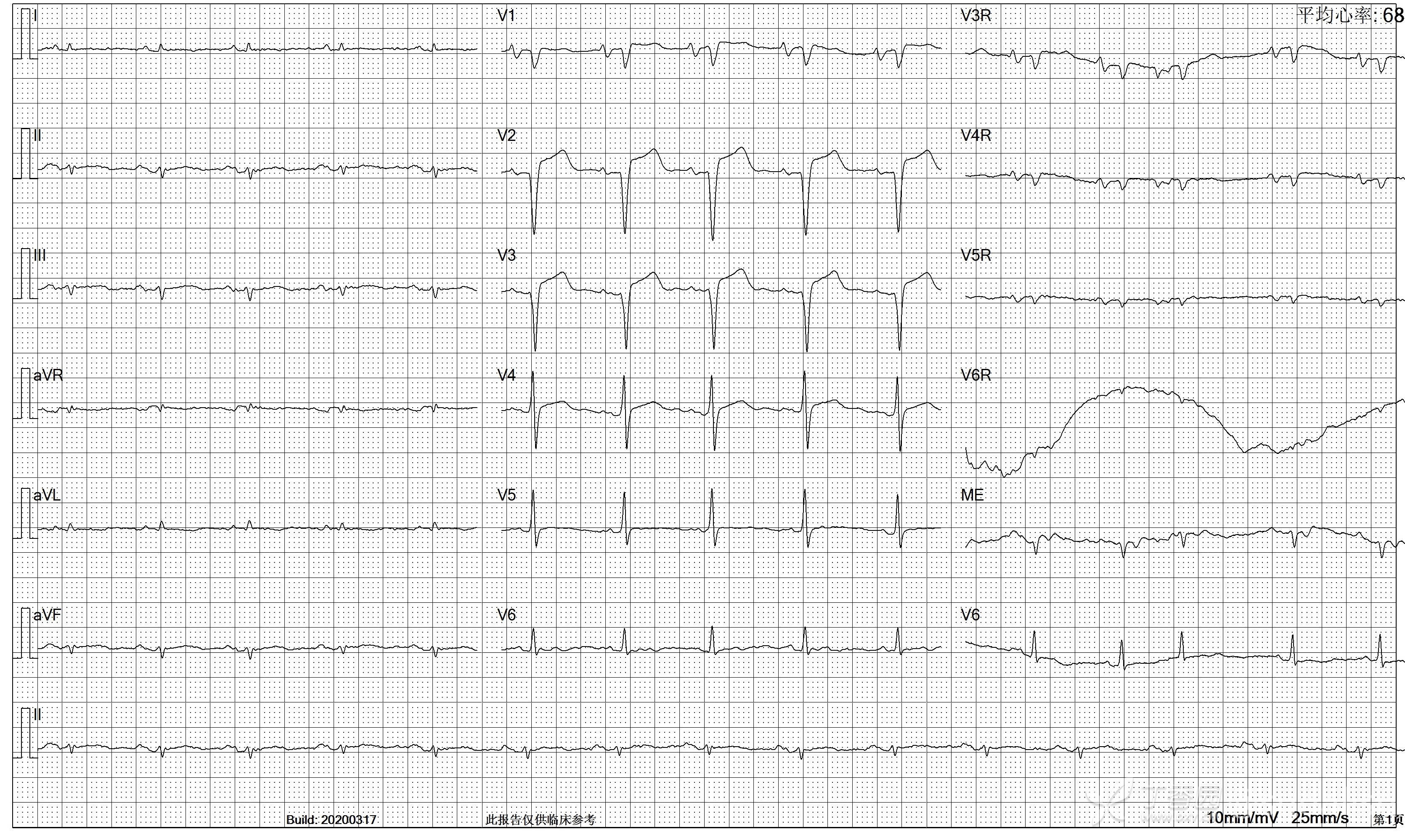 85岁老人下肢水肿是什么原因,92岁老人心衰引起脚水肿没事吧