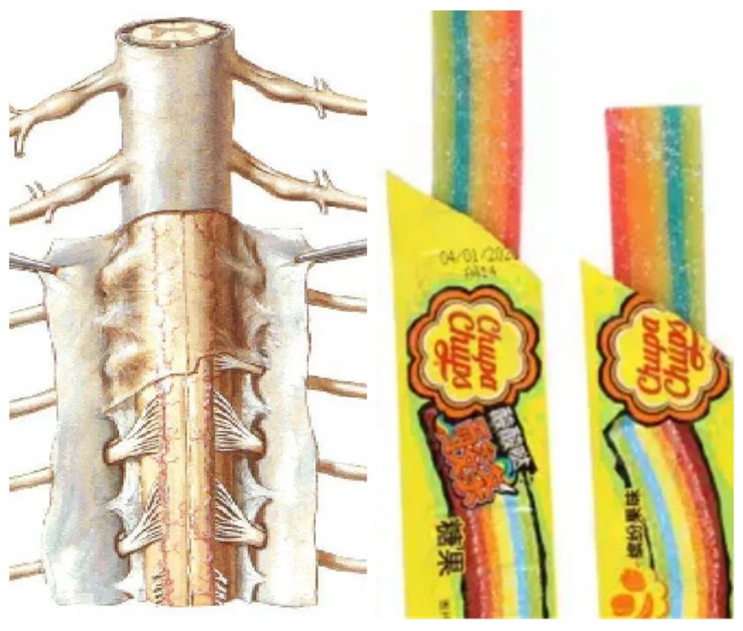 骶管囊肿是肿瘤吗？我该怎么办？