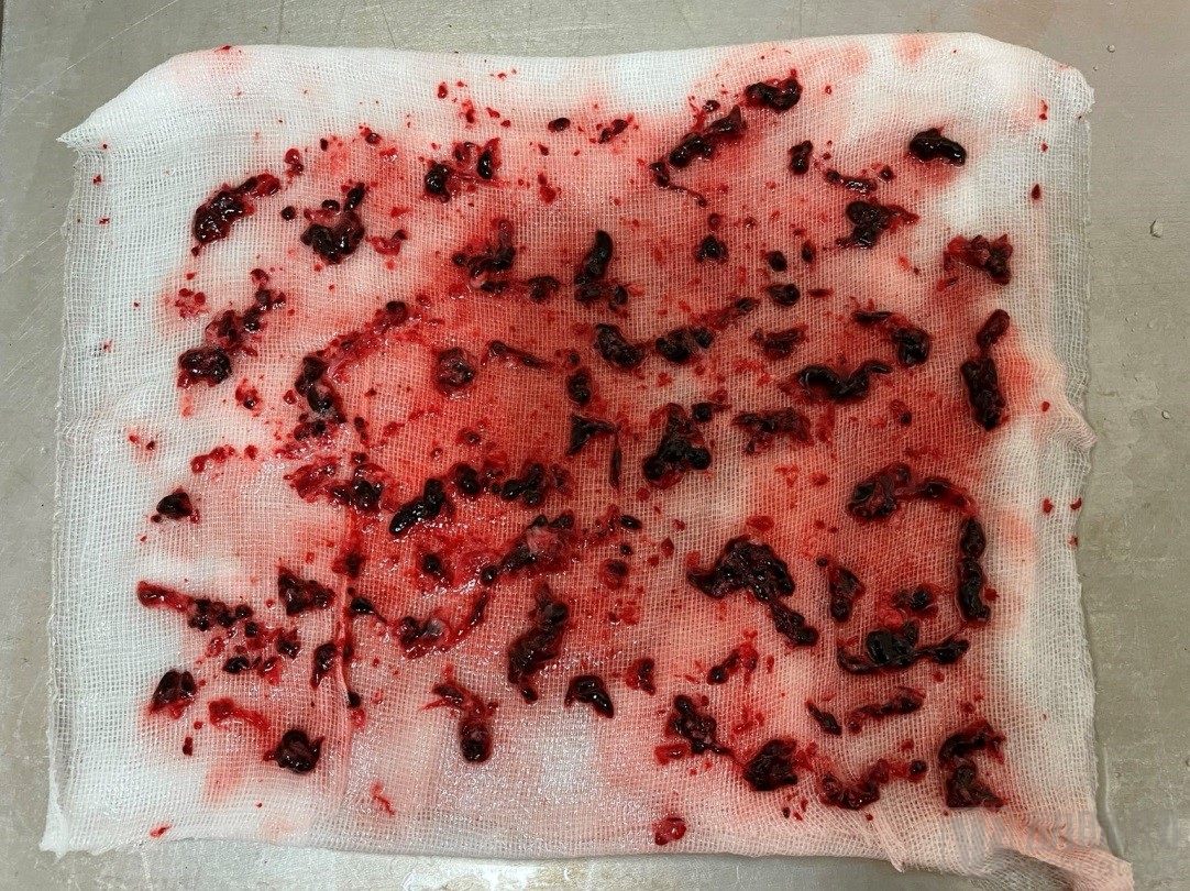 中国医院血栓清除技术,血栓消除的高端技术