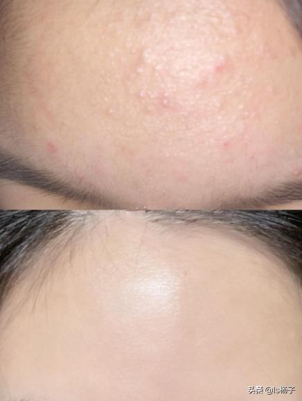 额头脸上长闭口粉刺怎么处理去除最好?小妙招小偏方(12招)