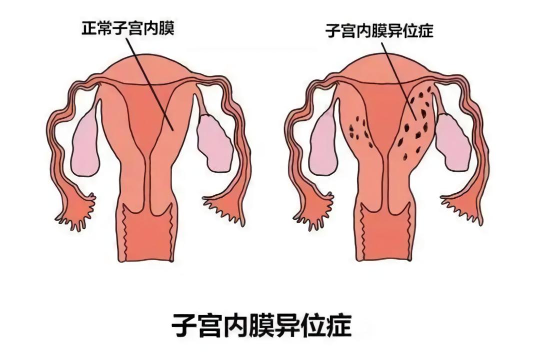 导致子宫内膜异位症患者不孕,造成不孕不育的隐形杀手