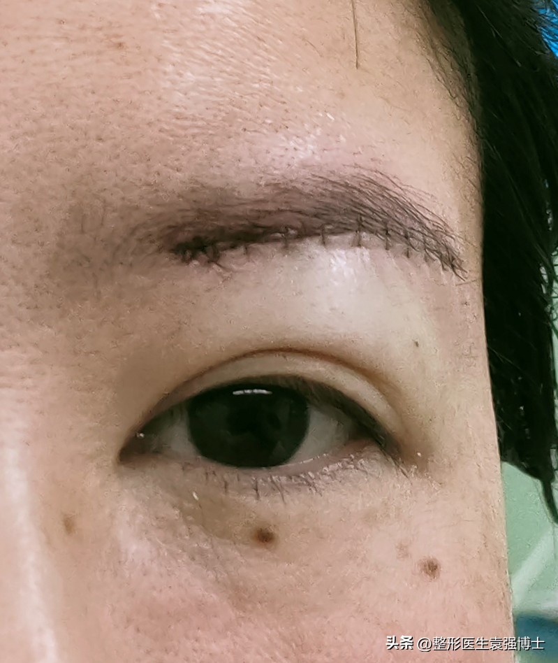 下眼皮下垂提眉能解决吗,眼皮下垂提眉和眼综合怎么选