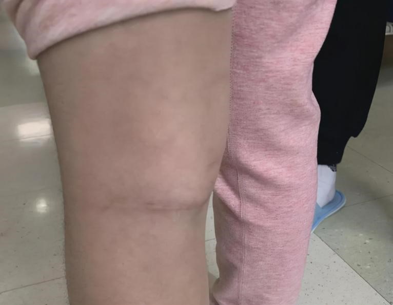 腿窝旁边起了一个鼓包是积液吗,腿左侧腘窝囊肿怎么治疗