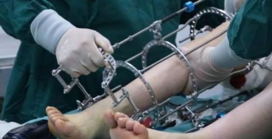 李亚诺断骨手术,断骨增高7.2厘米的李亚诺现状