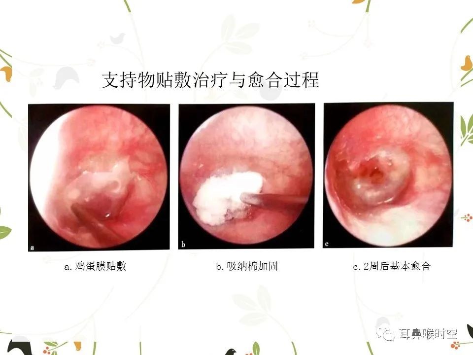 鼓膜可见穿孔,鼓膜穿孔听力下降能恢复吗