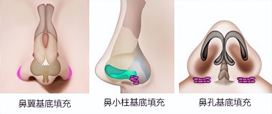 鼻基底填充法令纹瞬间消失,鼻基底填充后法令纹能改善多少