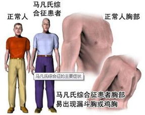 马凡综合征最长能活多少年,马凡综合征是天才病吗