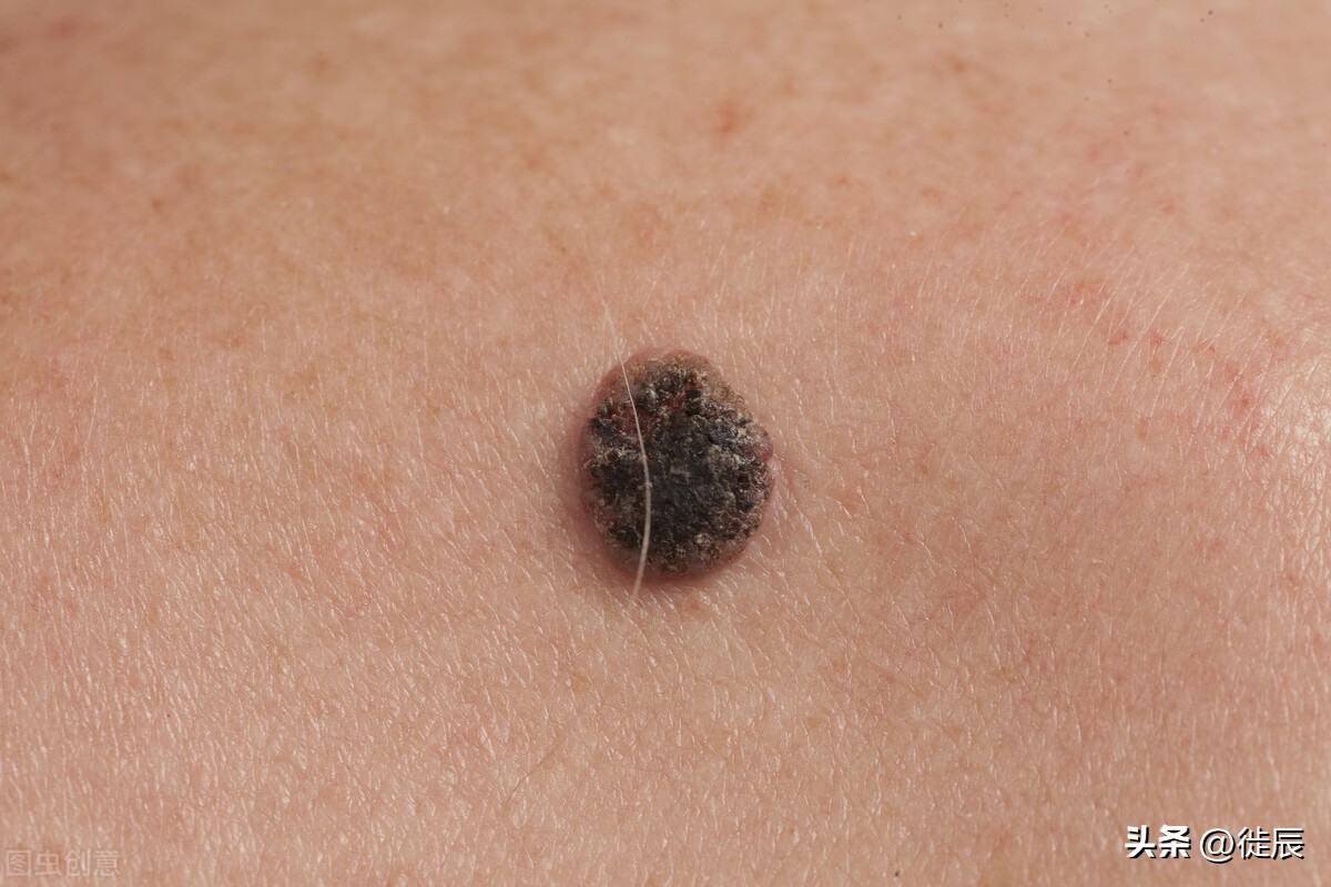 鳞癌肿瘤标志物查哪些,外阴鳞癌从体表能看出什么