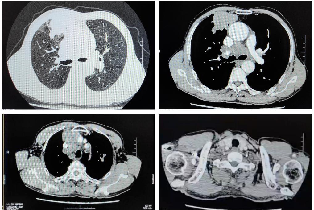 斯鲁利单抗治疗小细胞肺癌生存期,小细胞肺癌3a期用斯鲁利单抗