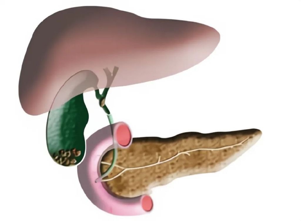 70斤巨型肿瘤被切除,六旬老妇体内竟有30斤巨型肿瘤
