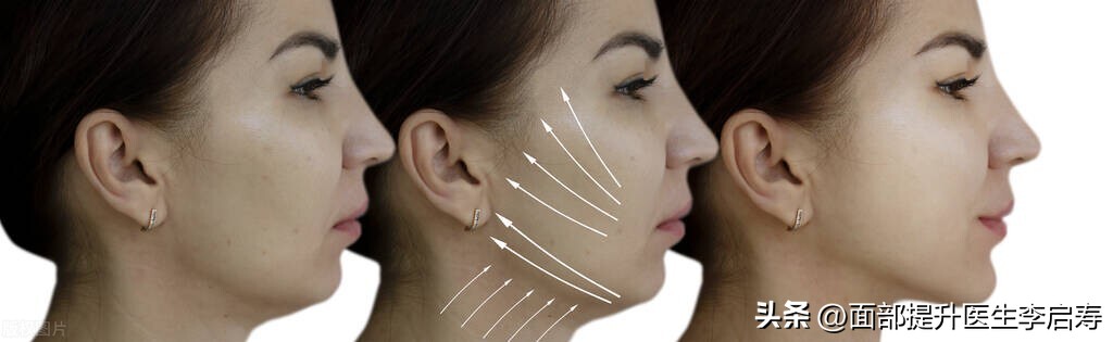 面部筋膜提升多久才是最佳效果,面部筋膜提升术5年后加速衰老
