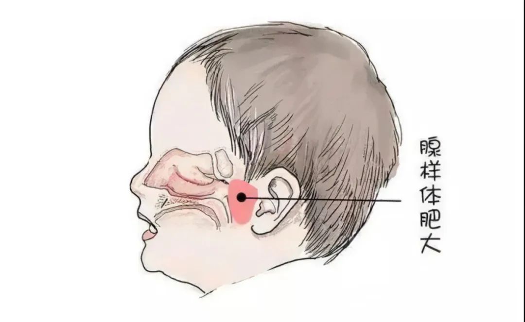 术后注意事项系列一儿童鼾症术后需要注意什么？