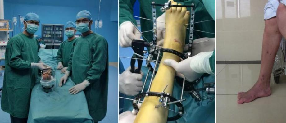 “走路的感觉真好。”手术让20多岁的脑瘫患者迈出人生第一步