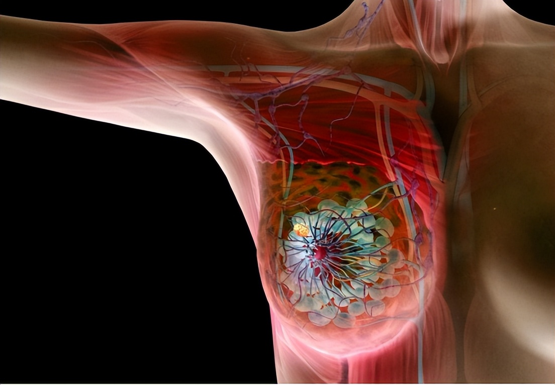 异时性双侧原发性乳腺癌10年,双侧原发性乳腺癌需要化疗吗