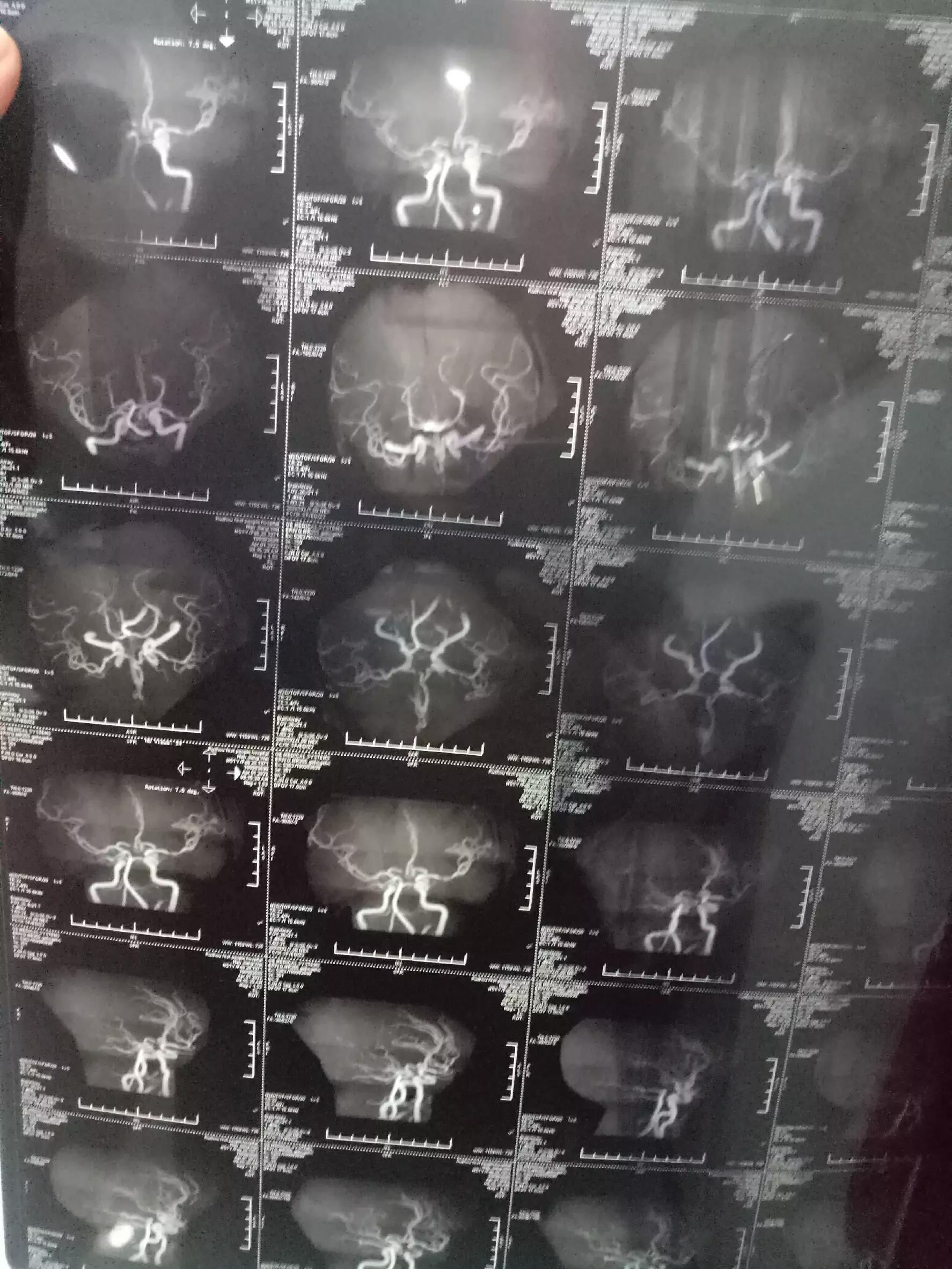 脑供血不足血压低建议住院,高血压短暂脑供血不足的症状