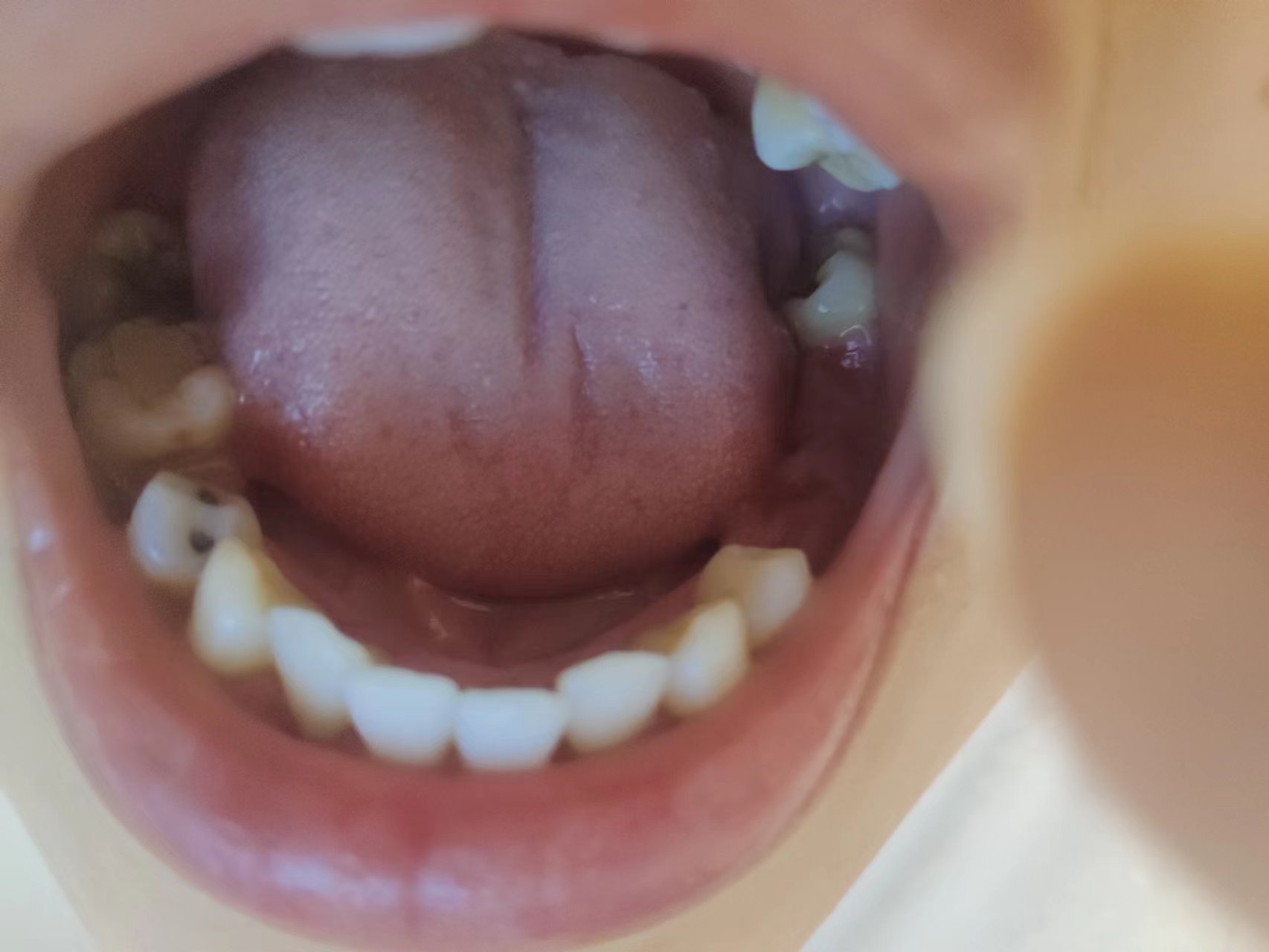 23岁还没有牙齿,30岁没牙